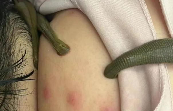 活体水蛭疗法.png 活体水蛭疗法.png