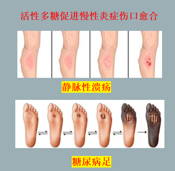 活性多糖促进慢性炎症伤口愈合.png 活性多糖促进慢性炎症伤口愈合.png