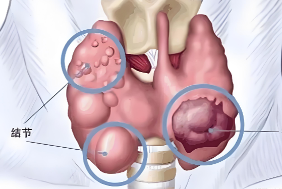 甲状腺结节钙化.png