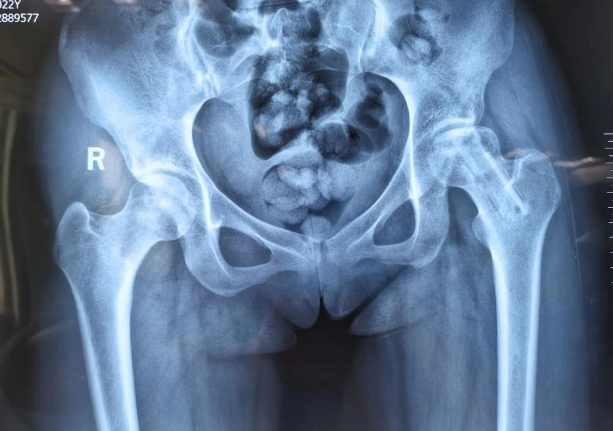 股骨对坏死怎么治疗.png 股骨对坏死怎么治疗.png