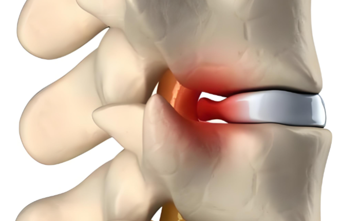 腰椎间盘突出.png 腰椎间盘突出.png