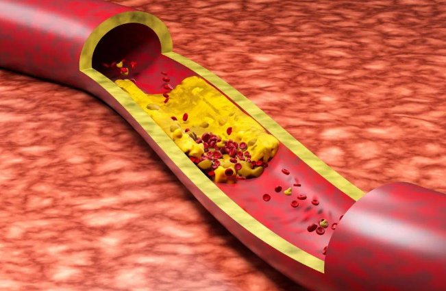 疏通血管.png 疏通血管.png