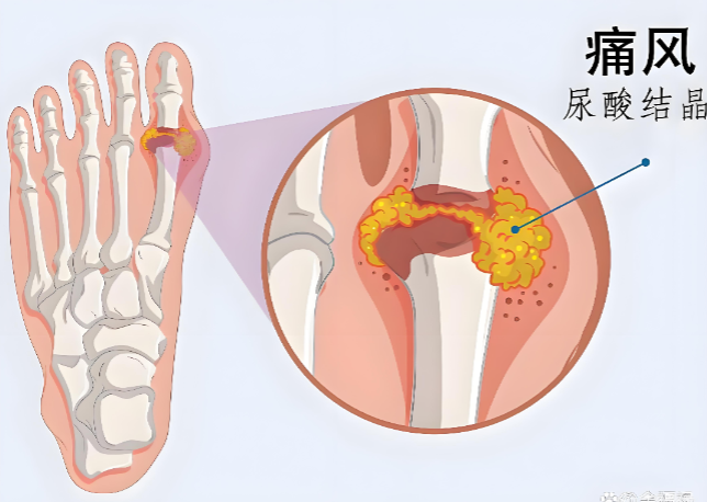 药食同源降尿酸.png
