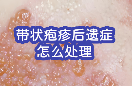 带状疱疹后遗症.png 带状疱疹后遗症.png