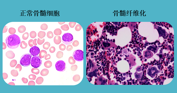 髓纤维化.png