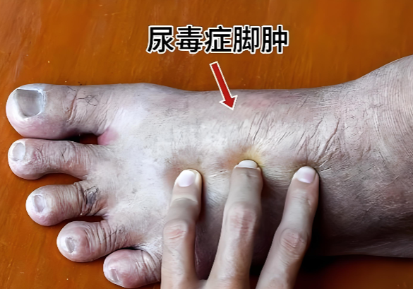 红宝胶囊与尿毒症.png