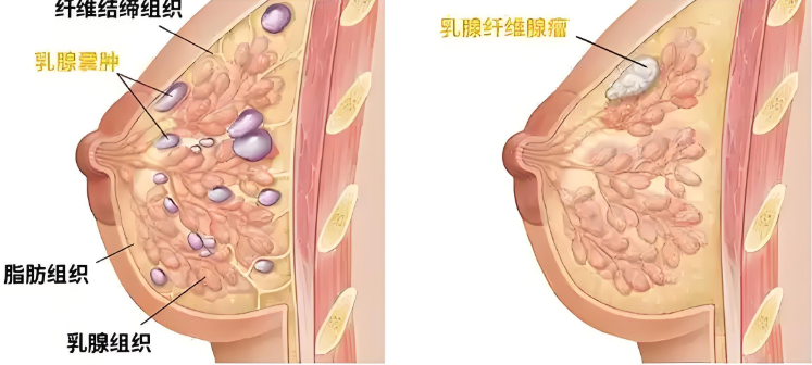 乳腺结节与增生.png