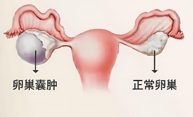 卵巢囊肿怎么治疗.png