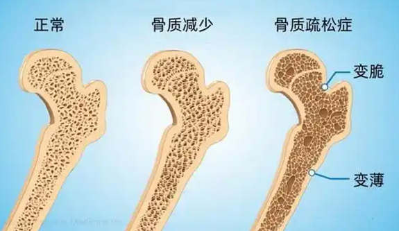 骨质疏松症.png 骨质疏松症.png